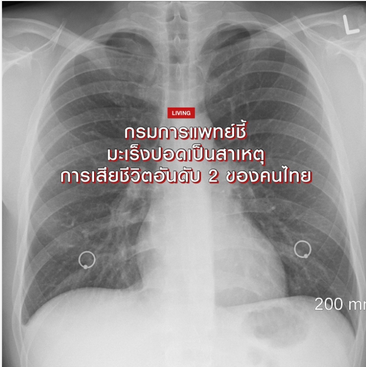 กรมการแพทย์ชี้ มะเร็งปอดเป็นสาเหตุ การเสียชีวิตอันดับ 2 ของคนไทย