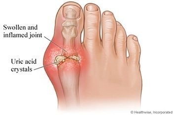 โรคเกาต์ - สาเหตุ อาการ และการรักษา …