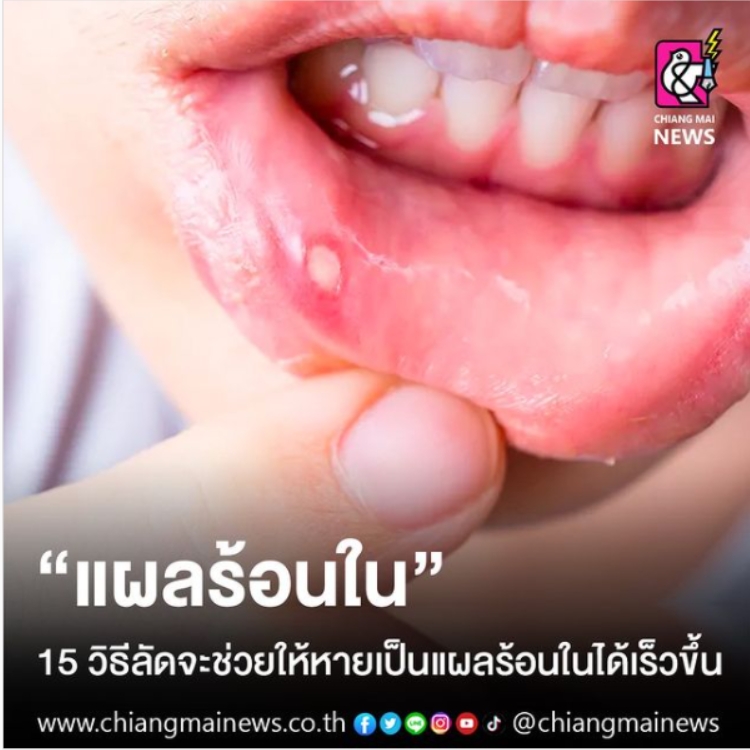 "แผลร้อนใน" 15 วิธีลัดจะช่วยให้หายเป็นแผลร้อนในได้เร็วขึ้น