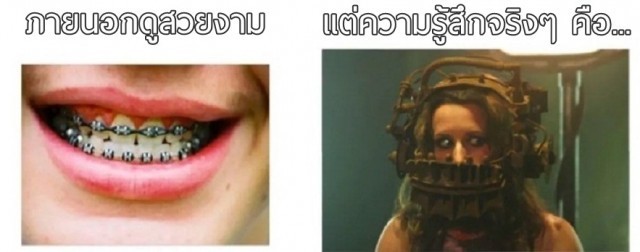 20 ความรู้สึกที่คน “จัดฟัน” ต้องเคยเจอ กว่าจะได้ฟันสวยแบบนี้มันไม่ใช่เรื่องง่ายเลยนะ