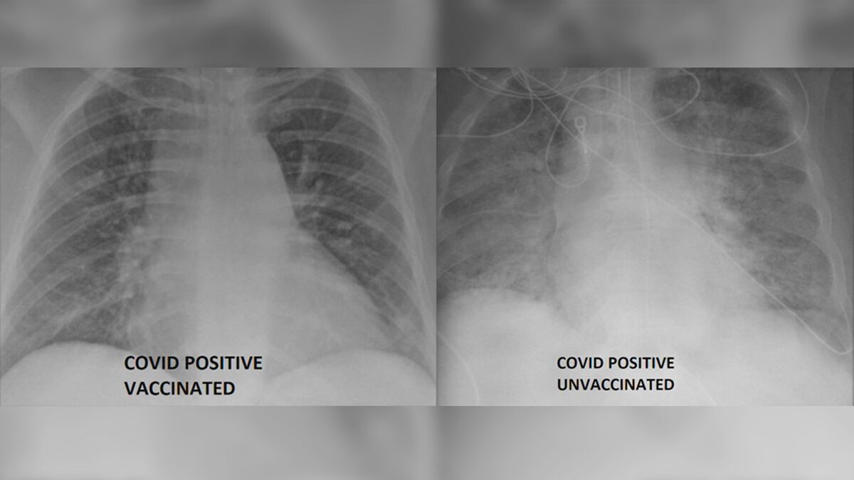 เทียบเอกซ์เรย์ผู้ป่วยโควิด “ไม่ฉีดวัคซีน” กับผู้ป่วยที่ “ฉีดแล้ว”