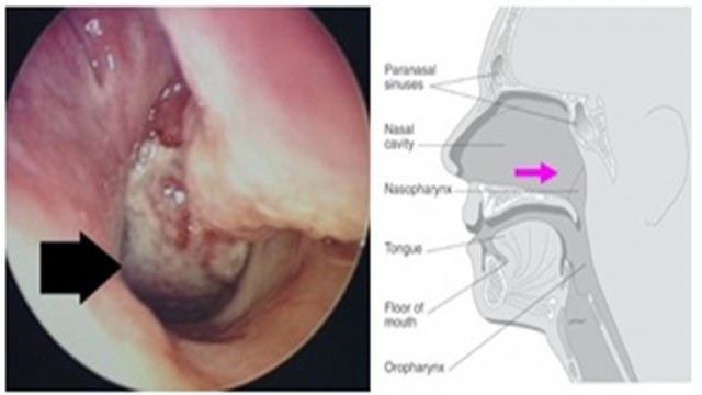 รู้จักโรค! “มะเร็งหลังโพรงจมูก” ภัยเงียบใกล้ตัวที่อาจมองข้าม