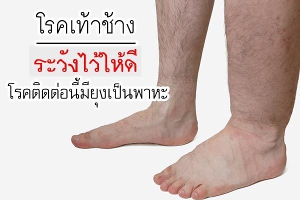 โรคเท้าช้าง ระวังไว้ให้ดี โรคติดต่อนี้มียุงเป็นพาหะ !