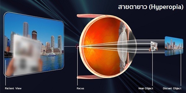 ทำไมสายตาเอียง รักษายากกว่าสายตาสั้นสายตายาว