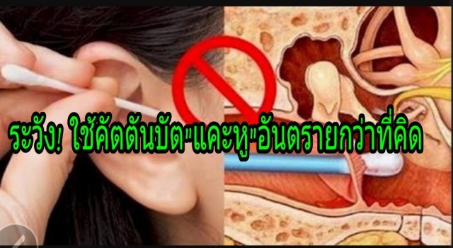 ระวัง!ใช้ก้านสำลีหรือคัตตอนบัต" แคะหู "อันตรายมากกว่าที่คิด