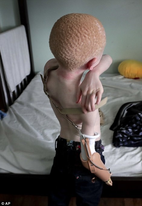 เหล่าเด็กๆ ผิวเผือกแทนซาเนีย ที่ถูกตัดแขนเพื่อนำไปขาย ได้รับอวัยวะเทียมทดแทนอีกครั้ง