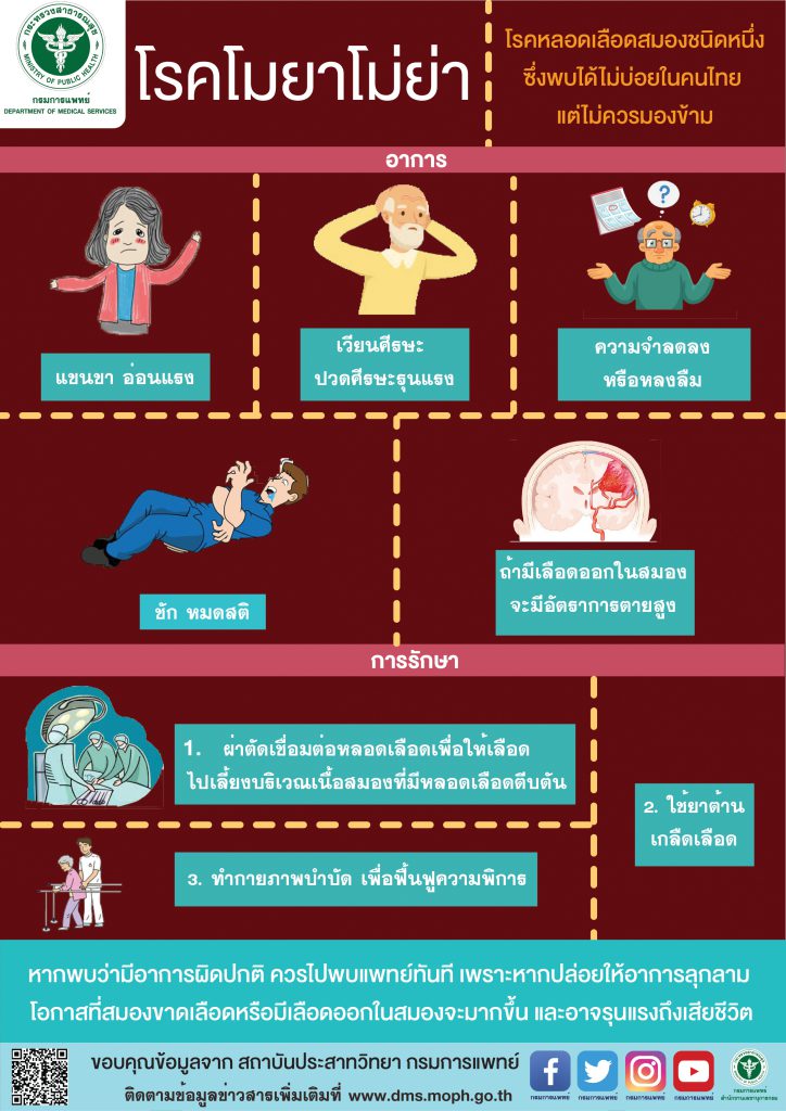 "โรคโมยาโมย่า"  เกิดได้น้อยแต่ไม่ควรมองข้าม