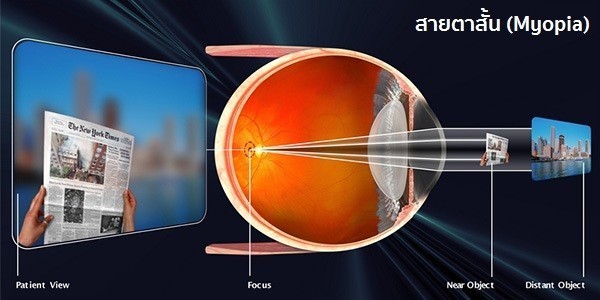 ทำไมสายตาเอียง รักษายากกว่าสายตาสั้นสายตายาว