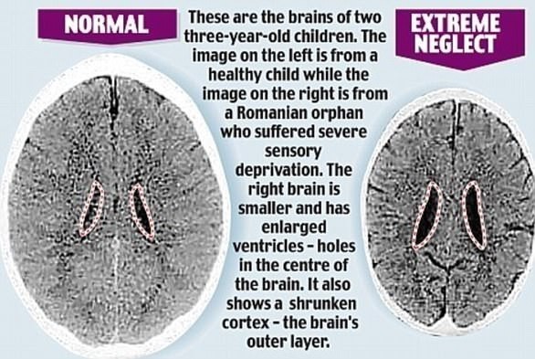 ความแตกต่างของภาพสแกนสมองของเด็กสองคน คนไหนถูกรักคนไหนถูกทำร้าย!?
