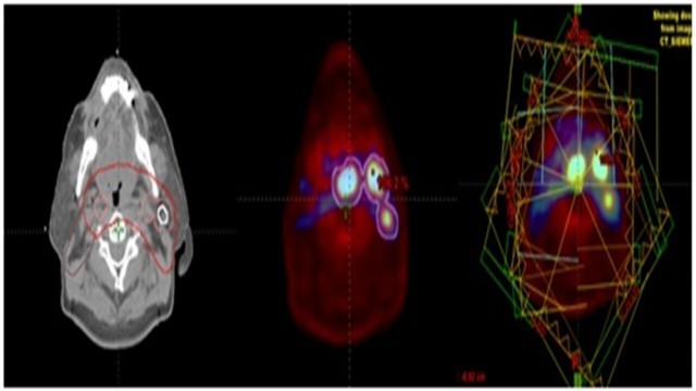 รู้จักโรค! “มะเร็งหลังโพรงจมูก” ภัยเงียบใกล้ตัวที่อาจมองข้าม