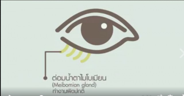การนวดและทำความสะอาดเปลือกตาเพื่อบรรเทาอาการตาแห้งเรื้อรัง