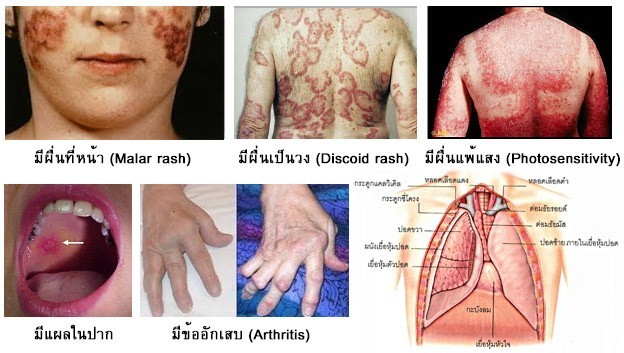 รู้จักโรค SLE (เอสแอลอี) หรือ โรคพุ่มพวง