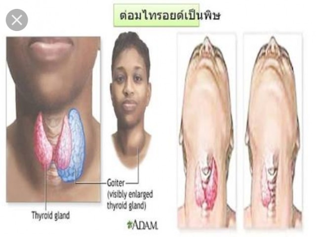 อัศจรรย์ !เพียงคุณทานสิ่งนี้ !!ไทรอยด์เป็นพิษ หายได้ ภายใน 2-3 อาทิตย์