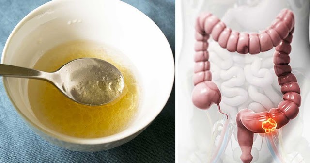 แพทย์ตะลึง! น้ำมันมะพร้าวฆ่าเซลล์มะเร็งในลำไส้ใหญ่ได้ถึง 93% ได้ในระยะเวลาอันสั้น