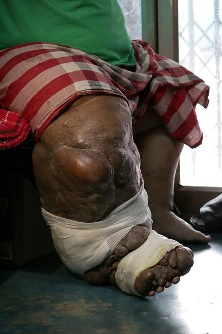 โรคเท้าช้าง ระวังไว้ให้ดี โรคติดต่อนี้มียุงเป็นพาหะ !