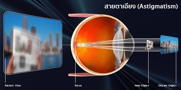 ทำไมสายตาเอียง รักษายากกว่าสายตาสั้นสายตายาว