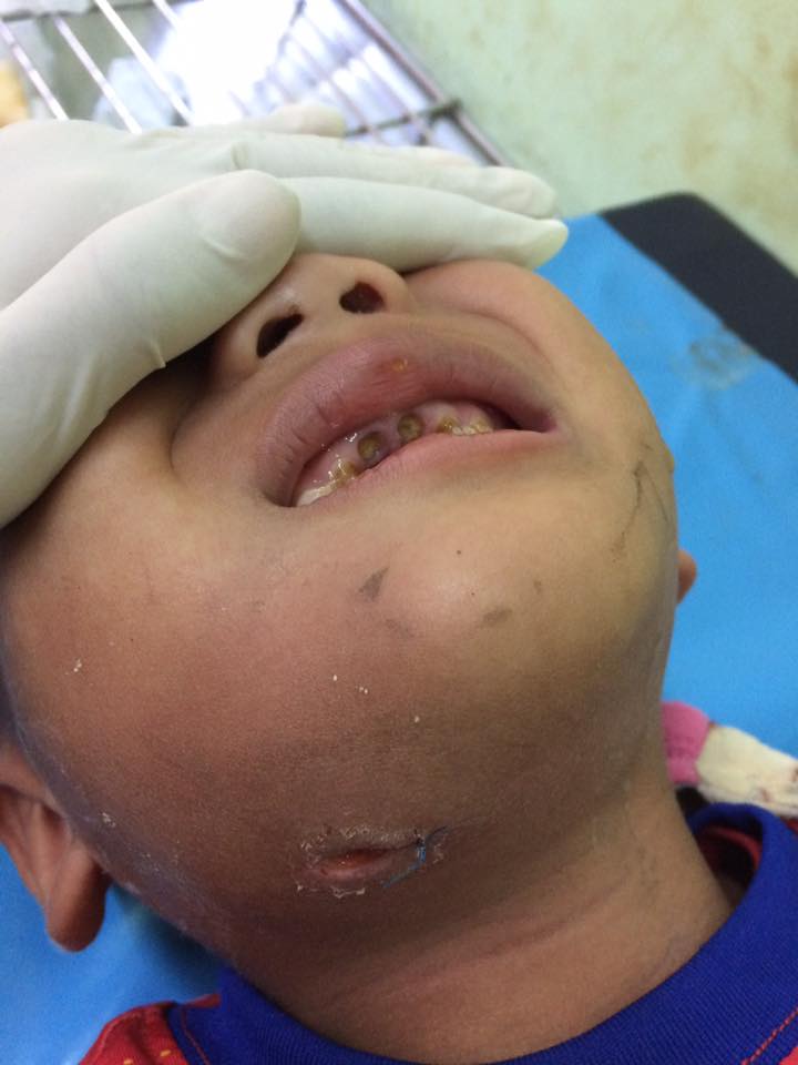 อุทาหรณ์ผู้ปกครอง ลูกฟันผุทะลุโพรงประสาทฟัน !!!
