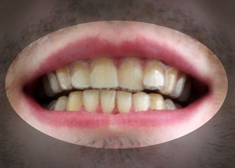 หนุ่มฝรั่งโชว์ผลงาน “จัดฟันเอง” แบบราคาประหยัด ด้วยเทคโนโลยีเครื่องพริ้นท์ 3 มิติ