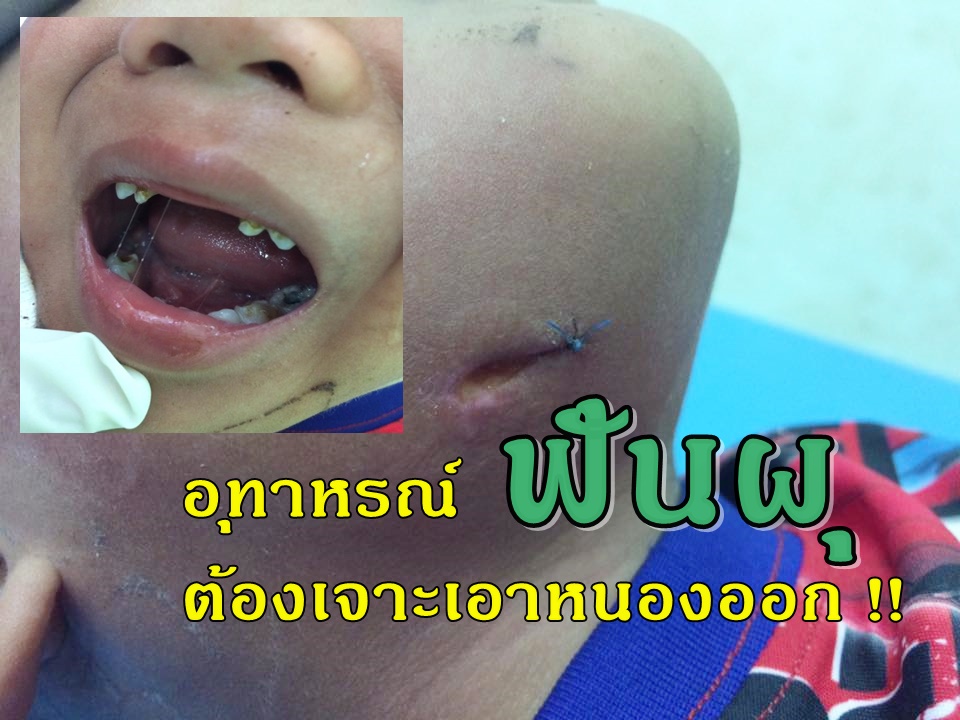 อุทาหรณ์ผู้ปกครอง ลูกฟันผุทะลุโพรงประสาทฟัน !!!