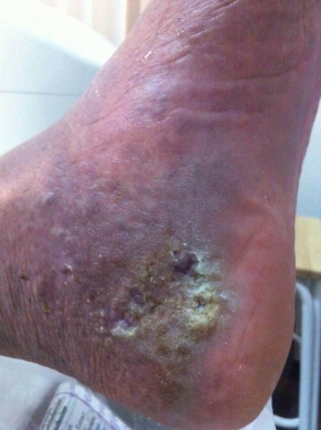 ศัลยแพทย์หลอดเลือดชี้ชัดอาการอาพาธของพระธัมมชโย อยู่ในระดับหก อันตรายสูงสุด