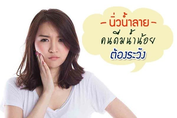 นิ่วน้ำลาย คนดื่มน้ำน้อย มีน้ำลายเหนียวบ่อย ๆ ต้องระวัง