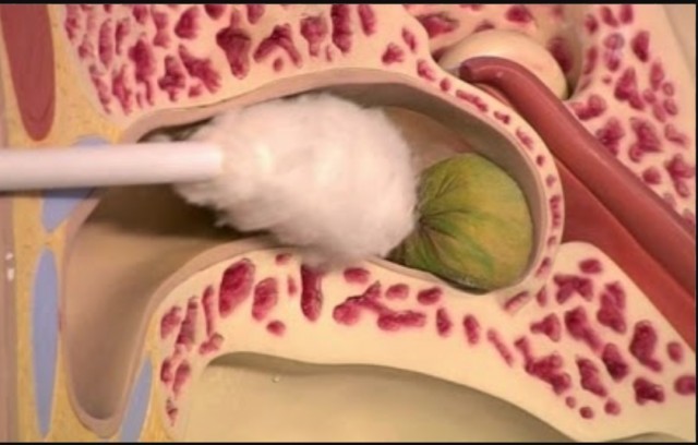 ระวัง!ใช้ก้านสำลีหรือคัตตอนบัต" แคะหู "อันตรายมากกว่าที่คิด